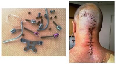 after my final operation